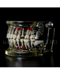 Arcada dentara  dinti detasabili + patologie molar inclus - cariologie - bont protetic 