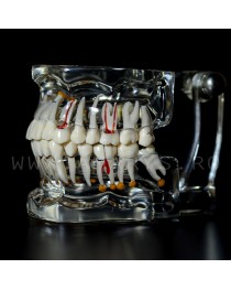 Arcada dentara patologie implant - endo - cario