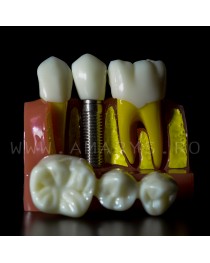 Model explicativ marit cu Implant+ Bont protetic +Coroana pe implant vs Lucrare dentara