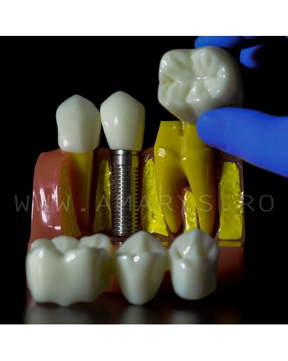 Model explicativ marit cu Implant+ Bont protetic +Coroana pe implant vs Lucrare dentara